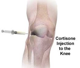 Does steroid shot in knee hurt